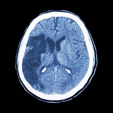 Stroke a Major Burden in the HIV Patient Population Stroke a Major Burden in the HIV Patient Population