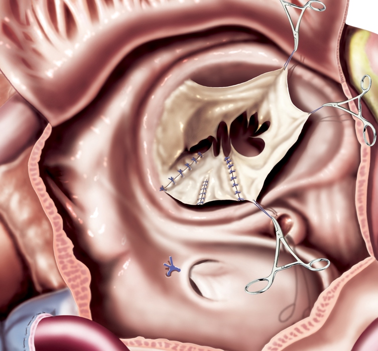 Mitral Valve Repair Success Rate