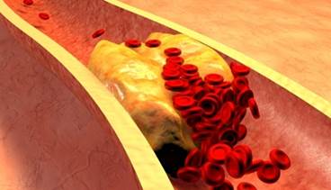 Lowering LDL Cholesterol HIV: Pitavastatin vs Pravastatin Lowering LDL Cholesterol HIV: Pitavastatin vs Pravastatin