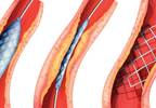 SYNTAX Scores Linked to Long-Term Revascularization Outcomes SYNTAX Scores Linked to Long-Term Revascularization Outcomes