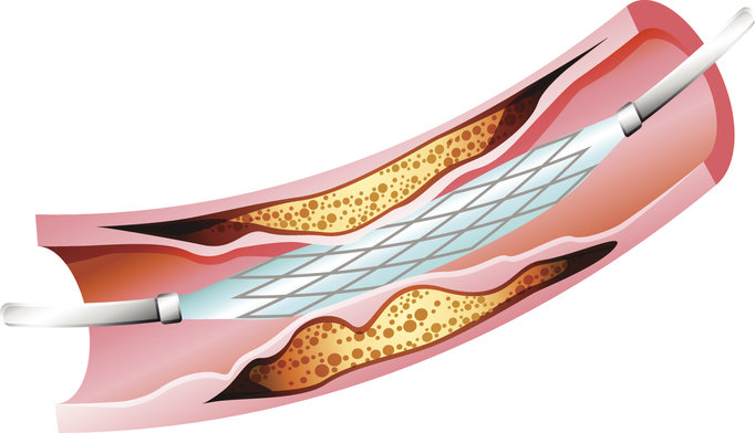 Interventional Cardiology A Look Back at 4 Decades of