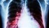 Childhood Asthma Linked With Increased Left Ventricular Mass In Adulthood Childhood Asthma Linked With Increased Left Ventricular Mass In Adulthood