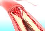 Deferred vs Complete Revascularization in Patients With Diabetes Deferred vs Complete Revascularization in Patients With Diabetes