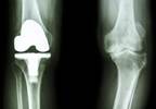 Heparin Does Not Prevent Venous Thromboembolism in Knee Arthroscopy Heparin Does Not Prevent Venous Thromboembolism in Knee Arthroscopy