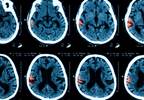 Intracranial Hemorrhage Risk Increased with Selective Serotonin Reuptake Inhibitors Intracranial Hemorrhage Risk Increased with Selective Serotonin Reuptake Inhibitors