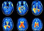 Overweight/Obesity Affects Brain Function in Type 2 Diabetes Overweight/Obesity Affects Brain Function in Type 2 Diabetes