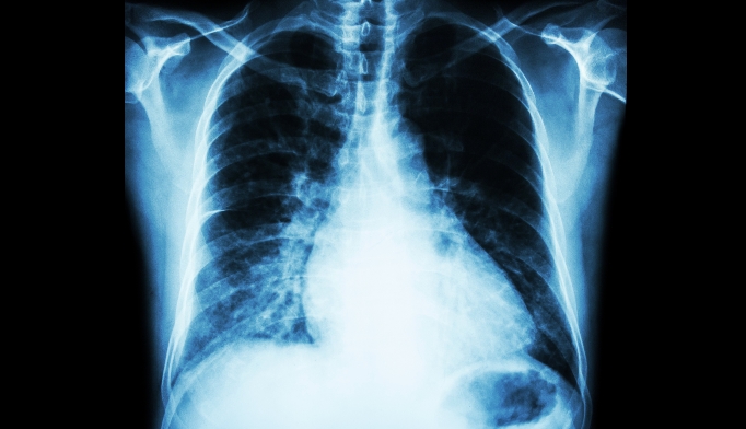 ischemic cva remedy