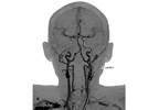History of Migraine Linked to Ischemic Stroke Via Cervical Artery Dissection History of Migraine Linked to Ischemic Stroke Via Cervical Artery Dissection