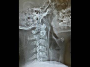 Case Study: Differential Diagnosis of Chest Pain With Radiation to the Neck Case Study: Differential Diagnosis of Chest Pain With Radiation to the Neck