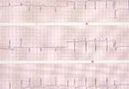 Obesity Paradox Reported for CVD Death Outcomes in Atrial Fibrillation Obesity Paradox Reported for CVD Death Outcomes in Atrial Fibrillation