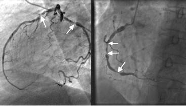 FOURIER Trial Data Questions: Are PCSK9 Inhibitors The Right Choice? FOURIER Trial Data Questions: Are PCSK9 Inhibitors The Right Choice?