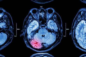 Improving Stroke Diagnosis Accuracy: An Expert Interview Improving Stroke Diagnosis Accuracy: An Expert Interview