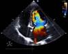 Lower Extremity Edema in a Woman With Heart Failure: A Case Study Lower Extremity Edema in a Woman With Heart Failure: A Case Study
