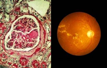 Intensive Glucose Control in Diabetes Reduces Kidney and Eye Events Intensive Glucose Control in Diabetes Reduces Kidney and Eye Events