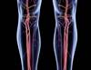 Peripheral Artery Disease-Related Leg Ischemia and Antihypertensive Use Peripheral Artery Disease-Related Leg Ischemia and Antihypertensive Use