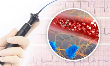 Atrial Fibrillation: Updates in Screening, Surgical Ablation, and Anticoagulation Use Atrial Fibrillation: Updates in Screening, Surgical Ablation, and Anticoagulation Use