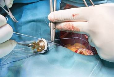 Avalus Surgical Aortic Valve Receives FDA and European Commission Approval Avalus Surgical Aortic Valve Receives FDA and European Commission Approval