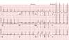 Case Study: Substernal Chest Pressure in a Young Man Case Study: Substernal Chest Pressure in a Young Man
