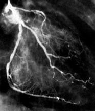 Independent Predictors Of Silent Coronary Artery Disease In 