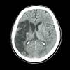 New Atrial Fibrillation After Stroke Tied to Preexisting Cardiovascular Comorbidities New Atrial Fibrillation After Stroke Tied to Preexisting Cardiovascular Comorbidities