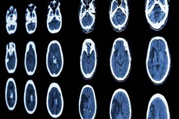 Reducing Neurologic Damage After Stroke With Ischemic Preconditioning Reducing Neurologic Damage After Stroke With Ischemic Preconditioning