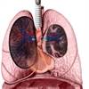 Chronic Thromboembolic PH Diagnosis and Management Update: Expert Q&A Chronic Thromboembolic PH Diagnosis and Management Update: Expert Q&A