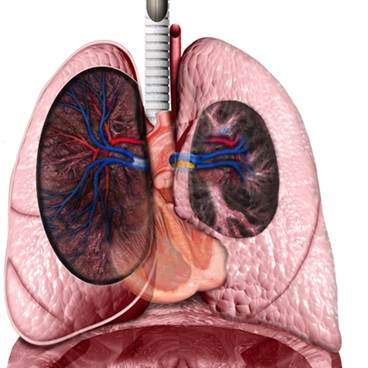 Chronic Thromboembolic PH Diagnosis and Management Update: Expert Q&A Chronic Thromboembolic PH Diagnosis and Management Update: Expert Q&A