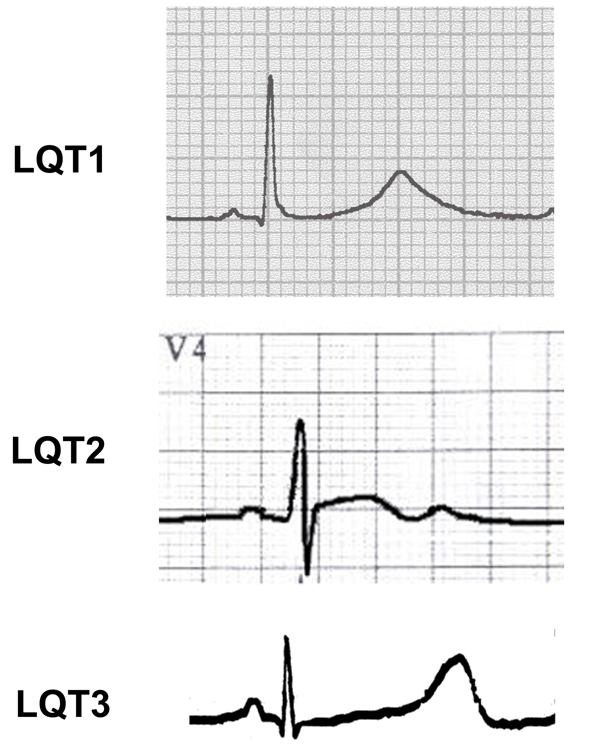Long QT Syndromes and Torsade de Pointes