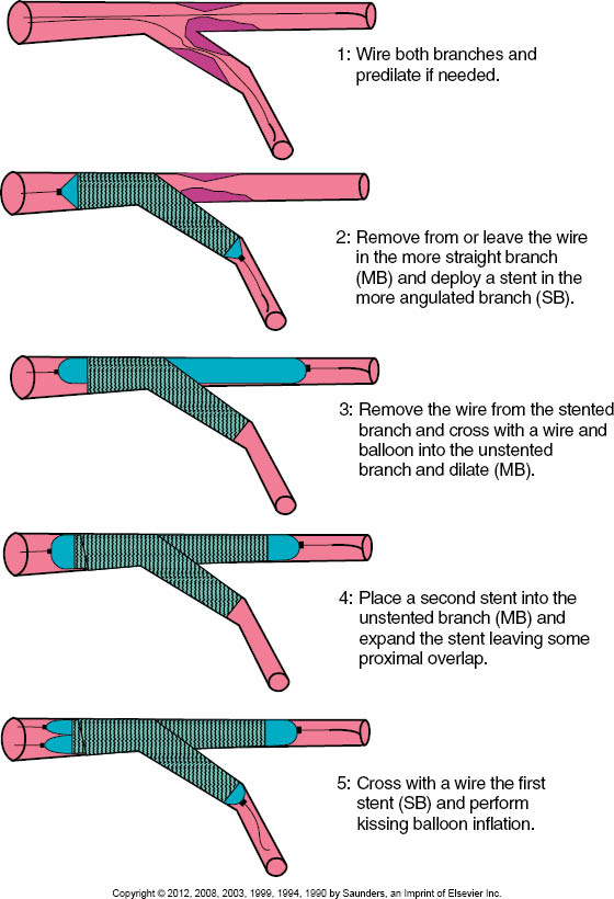 Bifurcation Lesions