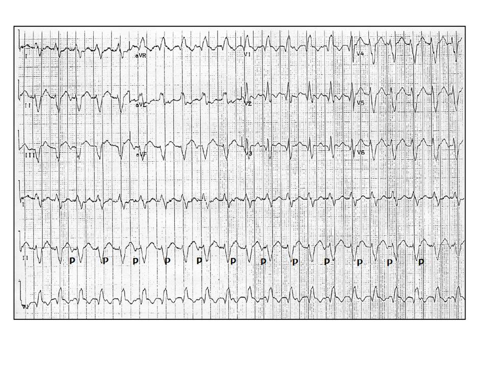 Differential Diagnosis of Wide QRS Complex Tachycardias