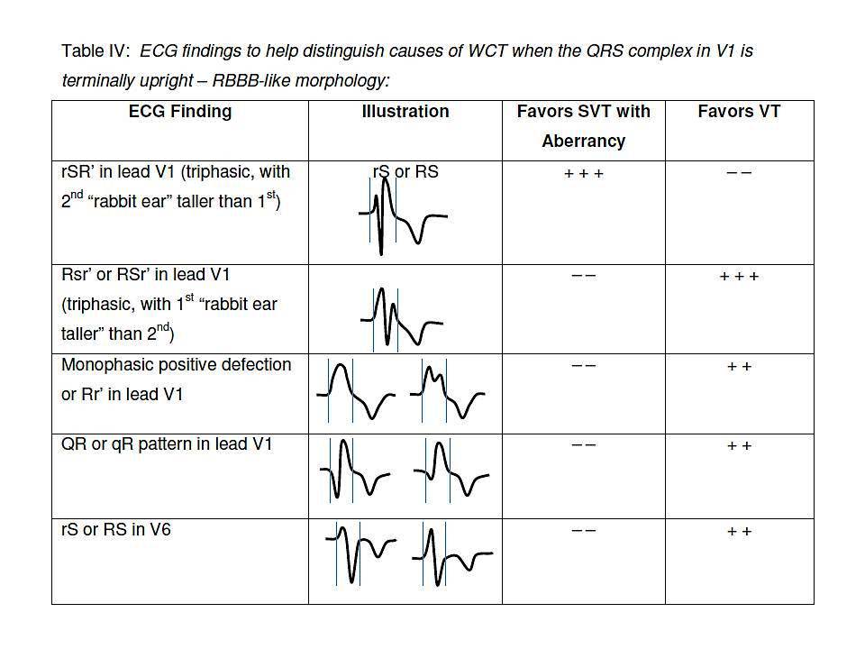 differential-diagnosis-of-wide-qrs-complex-tachycardias