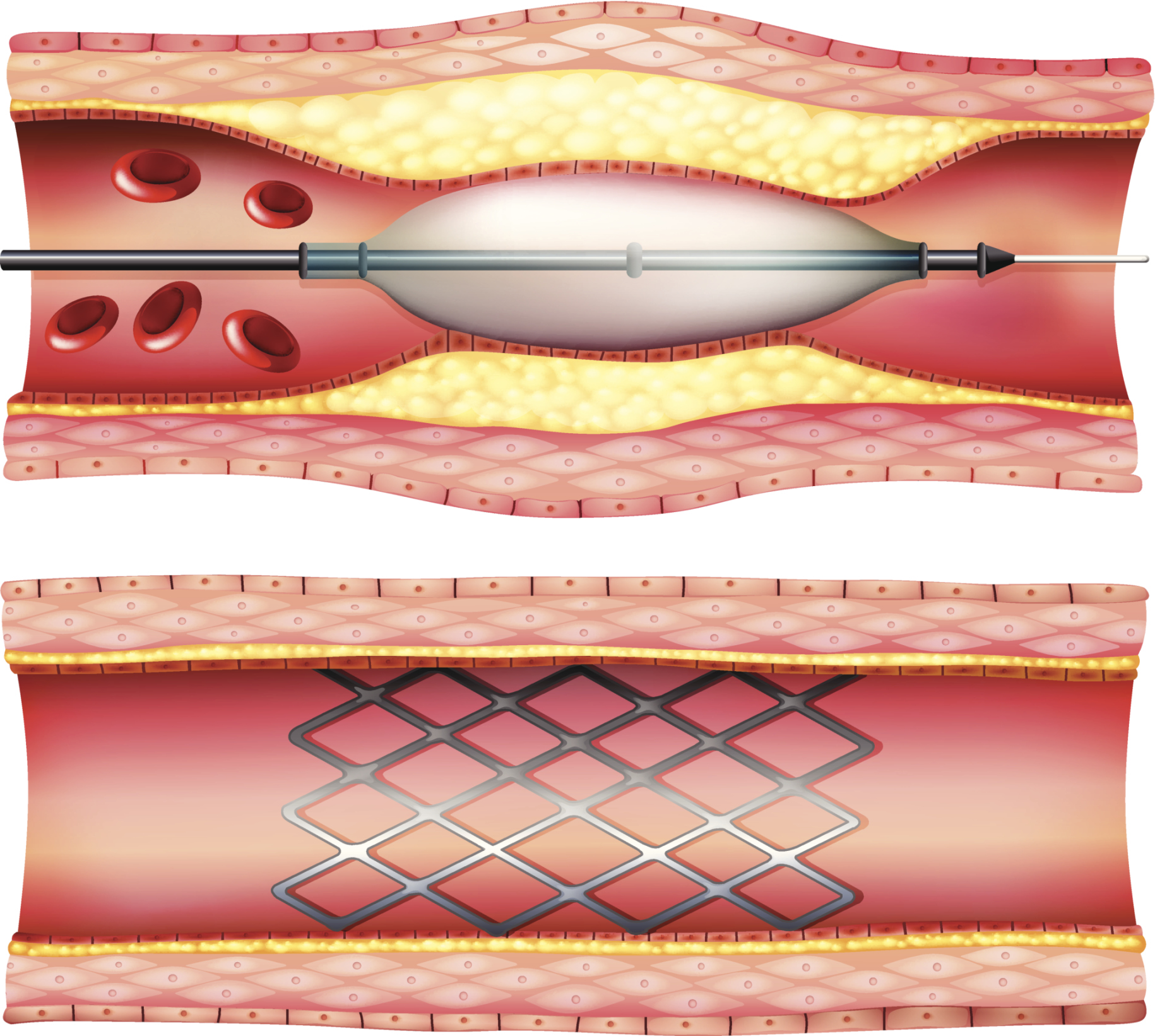 interventional-cardiology-a-look-back-at-4-decades-of-practice