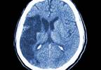 Stroke a Major Burden in the HIV Patient Population Stroke a Major Burden in the HIV Patient Population