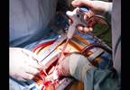 Adverse Events Risks Similar in Typical, Atypical Antipsychotics Adverse Events Risks Similar in Typical, Atypical Antipsychotics