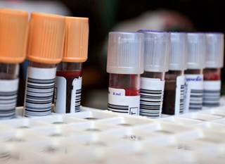 Patients with hepatitis C were 29% more likely to develop Parkinson's after accounting for age, sex and other health conditions. Patients with hepatitis C were 29% more likely to develop Parkinson's after accounting for age, sex and other health conditions.