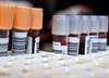 Hepatitis C May Increase Risk of Parkinson's Disease Hepatitis C May Increase Risk of Parkinson's Disease
