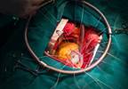 A Case of Heart Failure Secondary to Mitral Regurgitation A Case of Heart Failure Secondary to Mitral Regurgitation