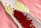 Femoral vs Carotid Plaque Screening for Coronary Artery Disease Risk Femoral vs Carotid Plaque Screening for Coronary Artery Disease Risk