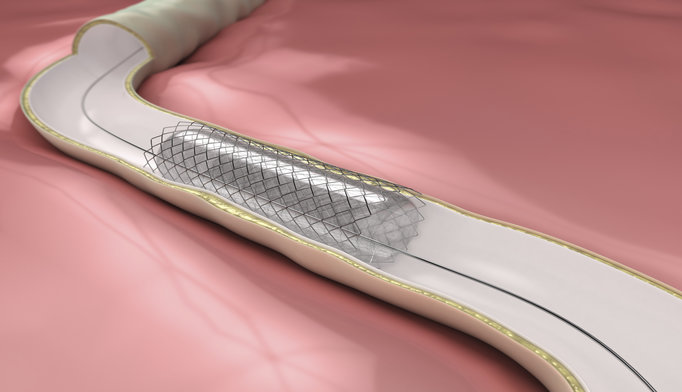 Pe stents dvt