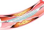 ABSORB Substudy: Bioresorbable Vascular Scaffold Safe for Diabetes ABSORB Substudy: Bioresorbable Vascular Scaffold Safe for Diabetes