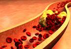 ADA: Clinical Benefit With Alirocumab in T2D Plus Statin Therapy ADA: Clinical Benefit With Alirocumab in T2D Plus Statin Therapy