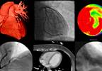 Novel Cardiac Magnetic Resonance Technique Detects Ischemia Without Gadolinium Contrast Novel Cardiac Magnetic Resonance Technique Detects Ischemia Without Gadolinium Contrast