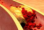 Lowering LDL Cholesterol HIV: Pitavastatin vs Pravastatin Lowering LDL Cholesterol HIV: Pitavastatin vs Pravastatin