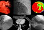 TNFi Therapy for Rheumatoid Arthritis Reduces Risk of Myocardial Infarction TNFi Therapy for Rheumatoid Arthritis Reduces Risk of Myocardial Infarction