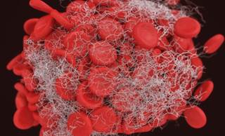 Reduced-dose DOACs may be as effective as full-dose treatment for recurrent VTE prevention. Reduced-dose DOACs may be as effective as full-dose treatment for recurrent VTE prevention.