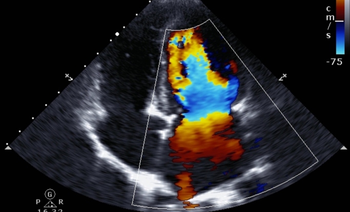 rheumatic-heart-disease-screening-by-nonexperts-in-echocardiography