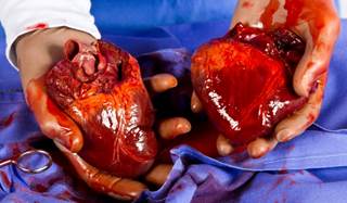 The patient is mildly febrile and laboratory results are overall unremarkable except for some mild neutropenia. The patient is mildly febrile and laboratory results are overall unremarkable except for some mild neutropenia.