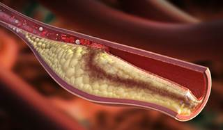Patients with systemic lupus erythematosus had a net progression of mean carotid intima-media thickness, with or without depression. Patients with systemic lupus erythematosus had a net progression of mean carotid intima-media thickness, with or without depression.
