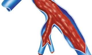 Incidence risk is lower with first superficial vein thrombosis after stopping anticoagulant therapy compared to those with proximal deep vein thrombosis. Incidence risk is lower with first superficial vein thrombosis after stopping anticoagulant therapy compared to those with proximal deep vein thrombosis.