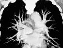 Residual Volume, Pulmonary Hyperinflation Increase Pulmonary Artery Size in COPD Residual Volume, Pulmonary Hyperinflation Increase Pulmonary Artery Size in COPD